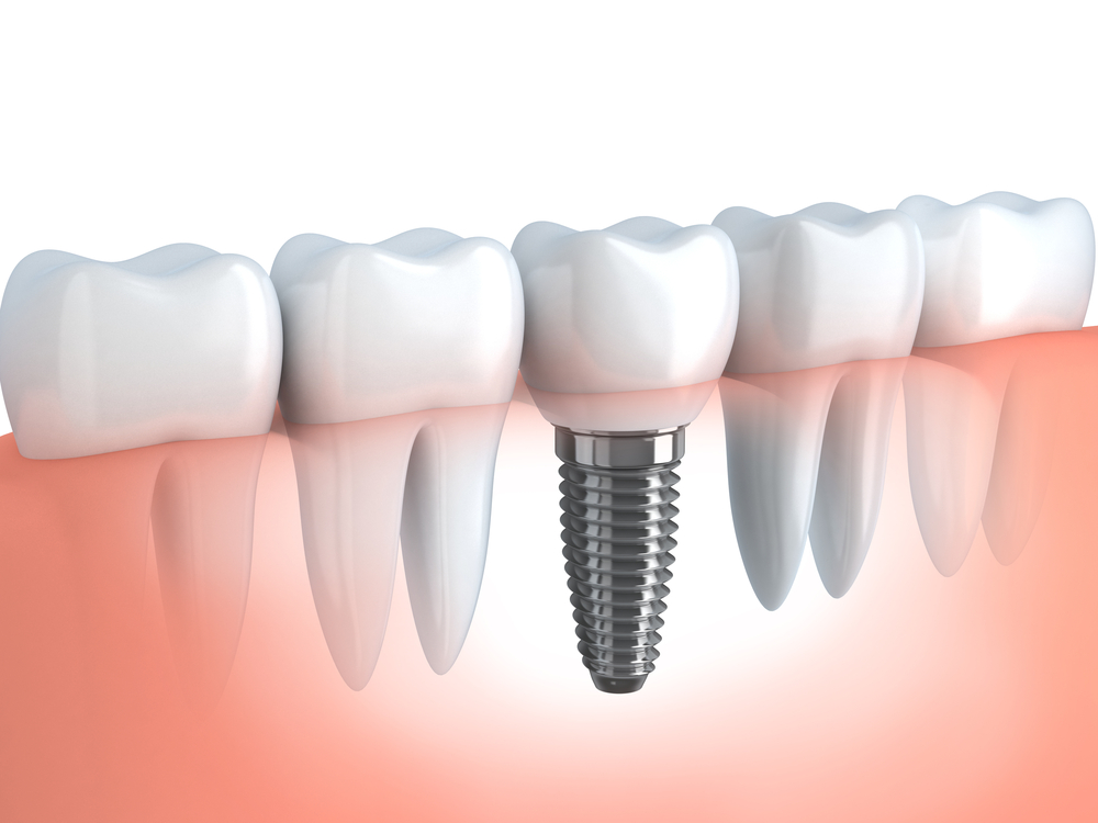 dental implants implant station park dental care dentist in farmington utah